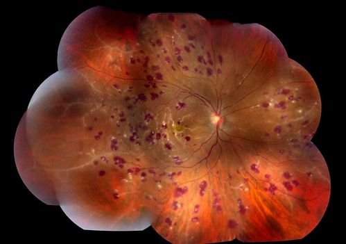 Retinal Vasculitis due to Lupus (color)
Systemic Lupus Erythematosis - Vasculitis
Schlüsselwörter: may2012
