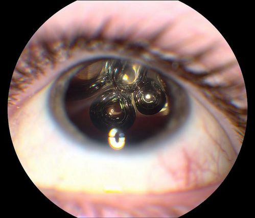 SF6 Gas Bubble 
Keywords: Retinal Detachment