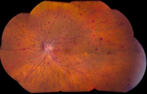 BDR
Keywords: Diabetic