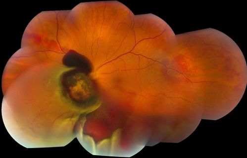 Choroidal Melanoma
Choroidal Melanoma with Retinal Detachment present inferior.
