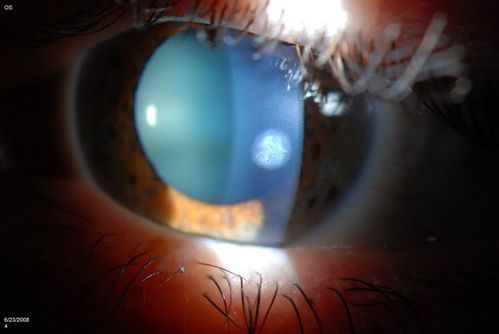 Cornea Ulcer scar
