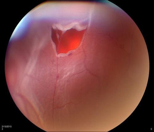 Horseshoe Retinal Tear with bridging blood vessel
Keywords: Retinal Detachment;may2012