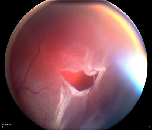 Horseshoe Retinal Tear with bridging blood vessel
Palabras clave: Retinal Detachment