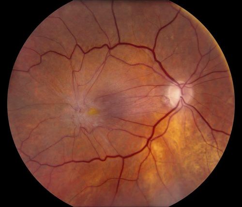 Keywords: macular pucker