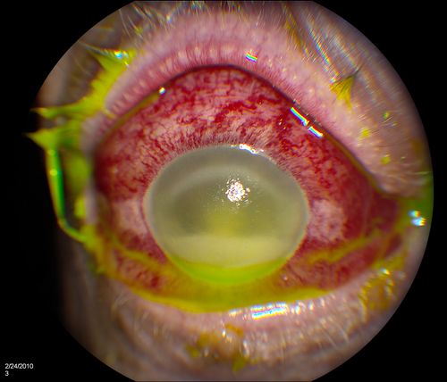 Endophthalmitis
