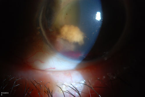 Ghost Cell Glaucoma
Post cataract surgery, patient presents with ghost cell in the anterior chamber after hemorrhage cleared. A small hyphema still is visible in the anterior chamber with a whitish ball appearance. 

