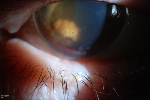Ghost Cell Glaucoma
Post cataract surgery, patient presents with ghost cell in the anterior chamber after hemorrhage cleared. A small hyphema still is visible in the anterior chamber with a whitish ball appearance. 
