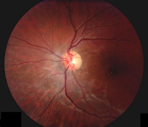 Keywords: macular pucker