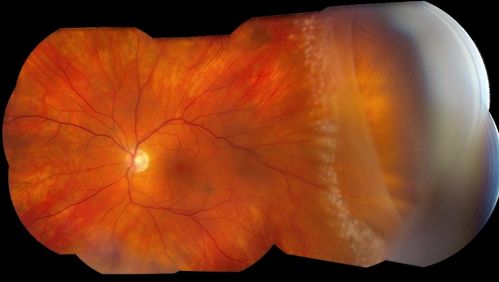 Montage of Retinal Tear after Laser Treatment
Keywords: Retinal Tear
