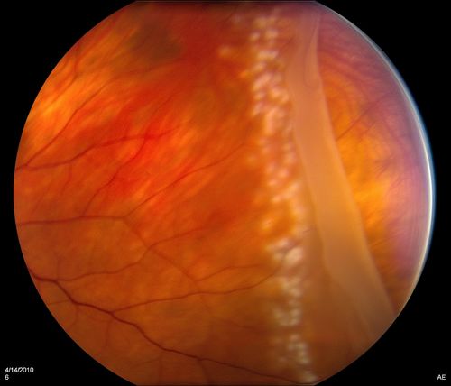 Giant Retinal Tear
Keywords: Retinal Detachment;august2012