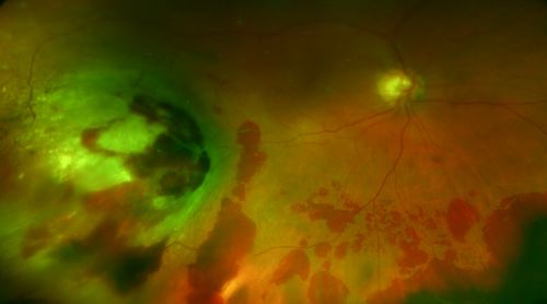 Treated Choroidal Melanoma
Patient that underwent proton therapy for choroidal melanoma. Fundus photo shows treated melanoma temporal inferior with scattered hemorrhages inferior of the retina. 

