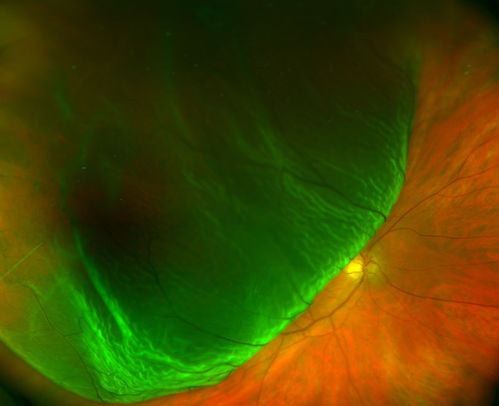 Bullous Retinal Detachment
Patient comes in with a curtain down in his vision in the right eye. Patient was hand motion. Fundus photograph shows retinal detachment with macula detached temporal superiorly in the right eye. There were 3-retinal tears between 10-12-o'clock. Schedule scleral buckle to fix RD.
Keywords: july2014