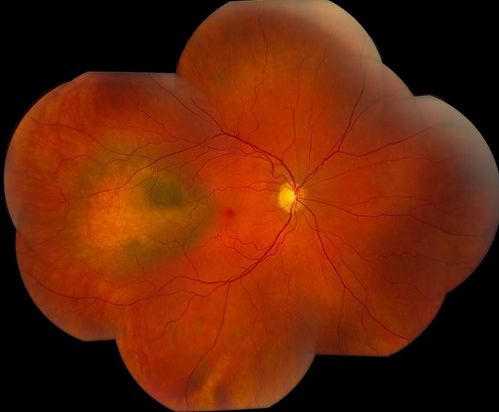 Choroidal Melanoma

