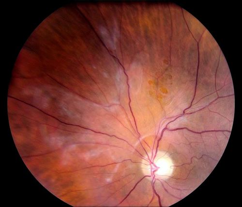 Mots-clés: macular pucker