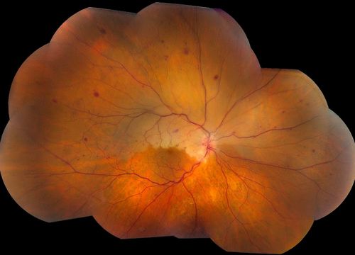 Montage of Hemi-Central Retinal Artery Occlusion
Keywords: CRAO