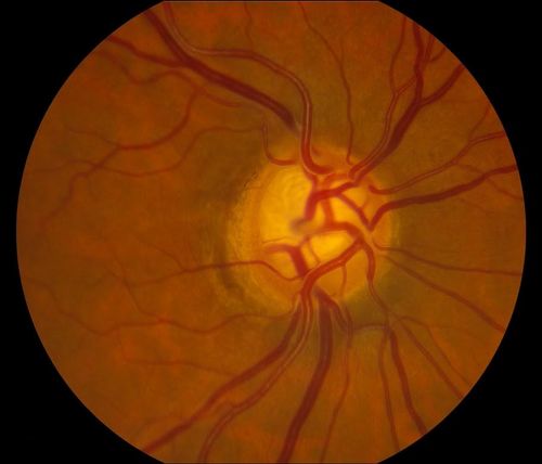 Glaucomatous optic nerve with severe cupping
Keywords: glaucoma