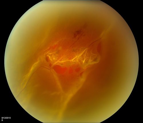 Retinal Tear
Keywords: Retinal Detachment