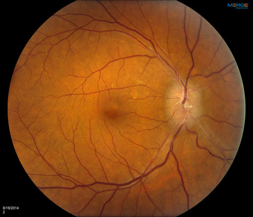 Bilateral Papilledema 
Young male presents with decreased vision in both eyes. Fundus photos reveal swollen optic nerves in both eyes.
