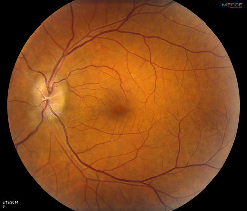 Bilateral Papilledema 
Young male presents with decreased vision in both eyes. Fundus photos reveal swollen optic nerves in both eyes.
