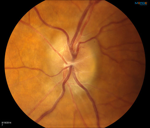 Bilateral Papilledema 
Young male presents with decreased vision in both eyes. Fundus photos reveal swollen optic nerves in both eyes.
Võtmesõnad: august2014