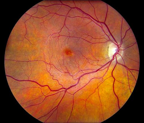 Keywords: macular pucker