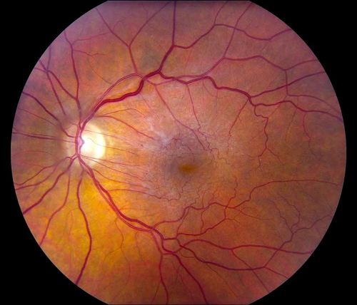 Keywords: macular pucker