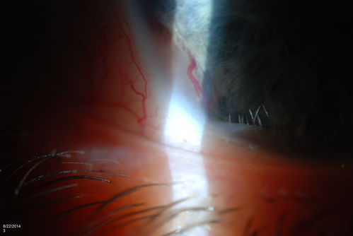 Gonioscopy, Mass in the Angle of Anterior Chamber
Slit Lamp and goinoscopy photos show a mass at 7-o'clock i the right eye. The mass extends beneath the iris behind the lens. 

