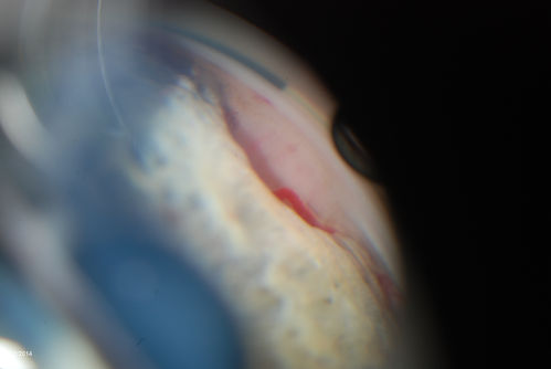 Gonioscopy, Mass in the Angle of Anterior Chamber
Slit Lamp and goinoscopy photos show a mass at 7-o'clock i the right eye. The mass extends beneath the iris behind the lens. 
