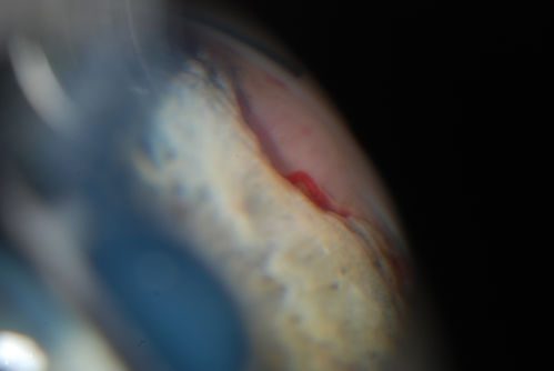 Gonioscopy, Mass in the Angle of Anterior Chamber
Slit Lamp and goinoscopy photos show a mass at 7-o'clock i the right eye. The mass extends beneath the iris behind the lens. 
Keywords: august2014