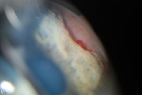 Gonioscopy, Mass in the Angle of Anterior Chamber
Slit Lamp and goinoscopy photos show a mass at 7-o'clock i the right eye. The mass extends beneath the iris behind the lens. 
