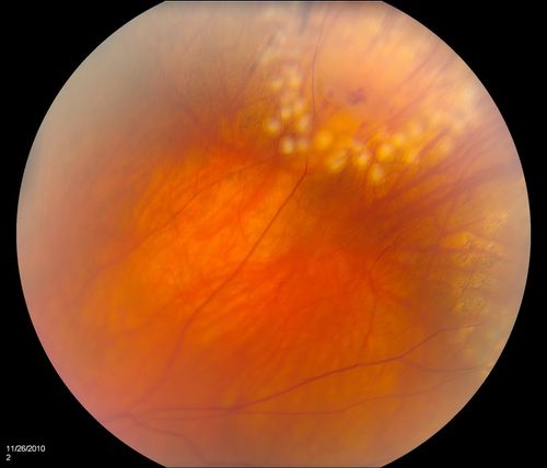 Retinal Tear treated with Laser 
Keywords: Retinal Detachment