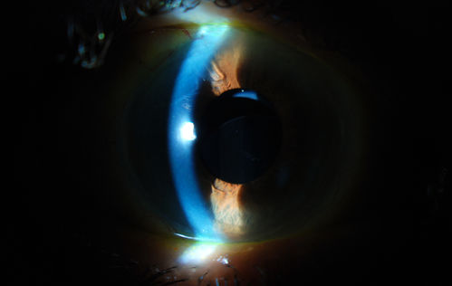 Dislocated IOL with Tube Shunt
Patient comes in with a dislocated lens in the right eye. Decreased vision in the right eye. Slit lamp photos shows lens dislocated halfway inferior. Ahmed Tube shut is visible at 11-o'clock superiorly in the right eye. 
