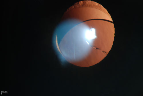 Dislocated IOL with Tube Shunt
Patient comes in with a dislocated lens in the right eye. Decreased vision in the right eye. Slit lamp photos shows lens dislocated halfway inferior. Ahmed Tube shut is visible at 11-o'clock superiorly in the right eye. 
