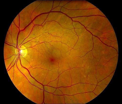Keywords: macular pucker