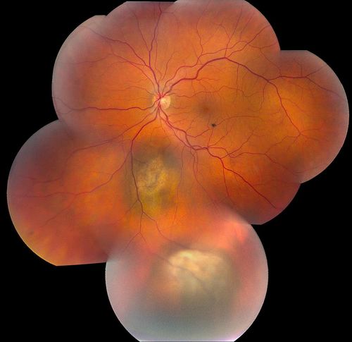 Choroidal Melanoma
