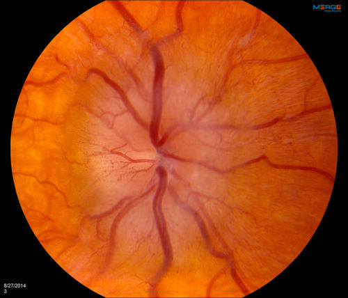 Bilateral Papilledema
Young female that presents with severe frequent headaches. VA is 20/15 in both eyes. Fundus exam reveals swelling of both optic nerves.
Keywords: september2014