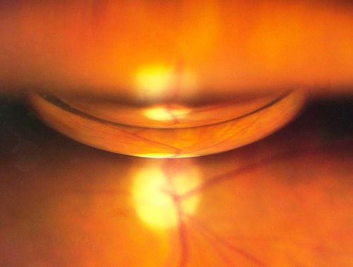 C3F8 Gas Bubble for retinal tear/ Pneumatic Retinopexy
Keywords: Retinal Detachment