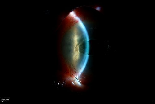 Cornea Ulcer/Abrasion
