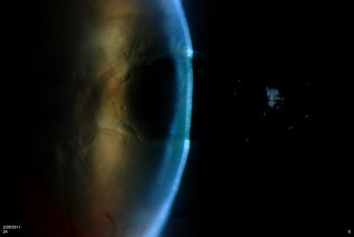 Cornea Ulcer/Abrasion
