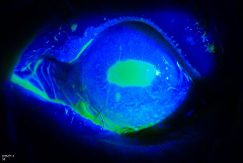 Cornea Ulcer/Abrasion
