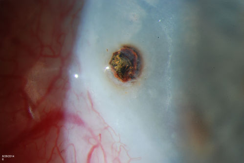Corneal Foreign Body
Patient comes in to the ER with foreign body sensation in his left eye. Patient was referred to Ophthalmology. Slit lamp shows metallic foreign body with rust ring nasally to the limbus in the left eye. Foreign body was removed with no complications..
