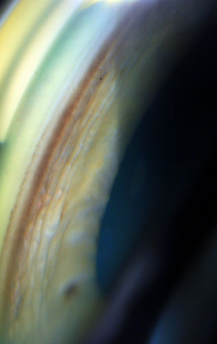 Gonioscopy, Pigment Dispersion Syndrome
Patient comes in with elevated pressures. Goinoscopy shows heavy pigment dusted off the iris into the trabecular meshwork. Laser procedure was done to break up the pigment for more aqueous flow.
