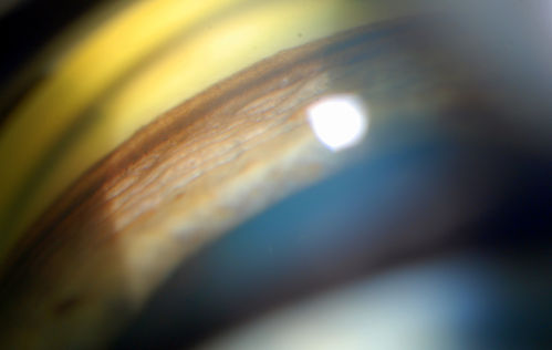 Gonioscopy, Pigment Dispersion Syndrome
Patient comes in with elevated pressures. Goinoscopy shows heavy pigment dusted off the iris into the trabecular meshwork. Laser procedure was done to break up the pigment for more aqueous flow.
