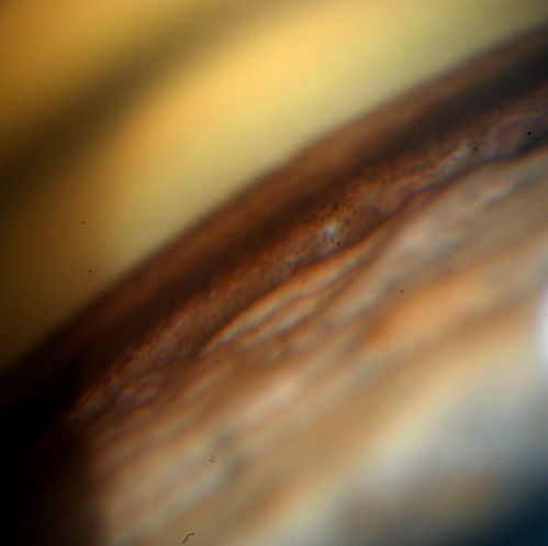 Gonioscopy, Pigment Dispersion Syndrome
Patient comes in with elevated pressures. Goinoscopy shows heavy pigment dusted off the iris into the trabecular meshwork. Laser procedure was done to break up the pigment for more aqueous flow.
