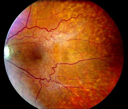 Keywords: macular pucker