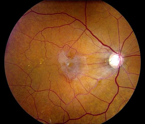 Keywords: macular pucker