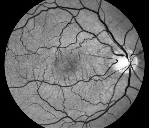 Keywords: macular pucker