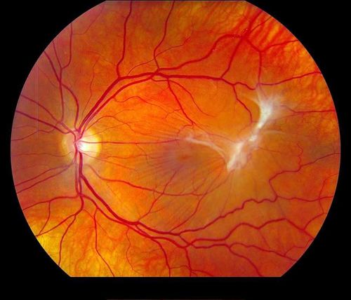 Keywords: macular pucker
