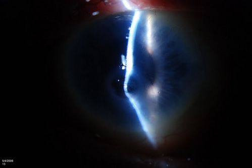 Cornea Ulcer
