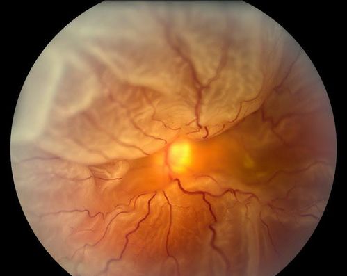 Retinal Detachment
Keywords: Retinal Detachment